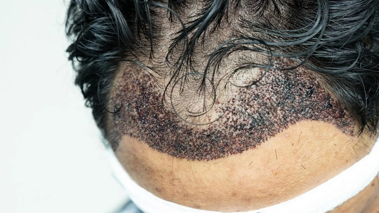 Przeszczep włosów - jakie są skutki uboczne?